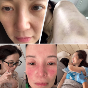 Shocking Photos: Kris Aquino revealed her flare-ups to inform the public about the serious condition of her illness—the real story behind the photo.