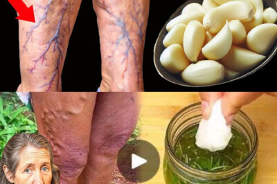 “Unbelievable! 🤩 Destroys varicose veins and inflammation naturally (Did you know that?)(DG)