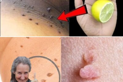 How to Remove Skin Tags at Home with Lemon and Ginger(DG)